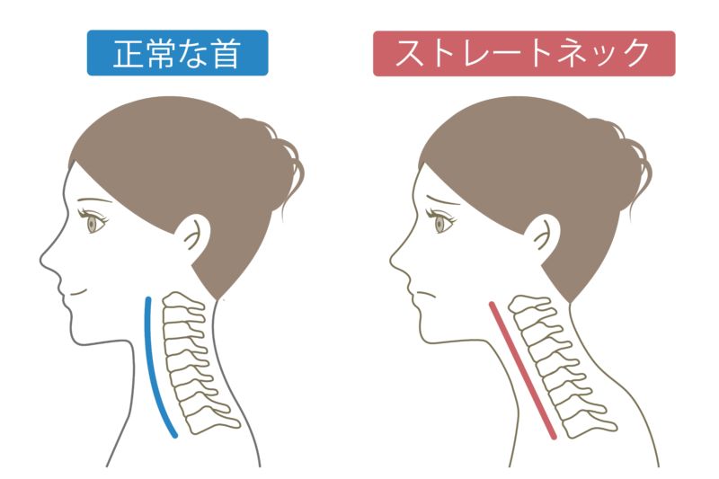 ストレートネックとは